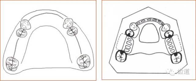 可摘局部义齿的肯氏(kennedy)分类及设计