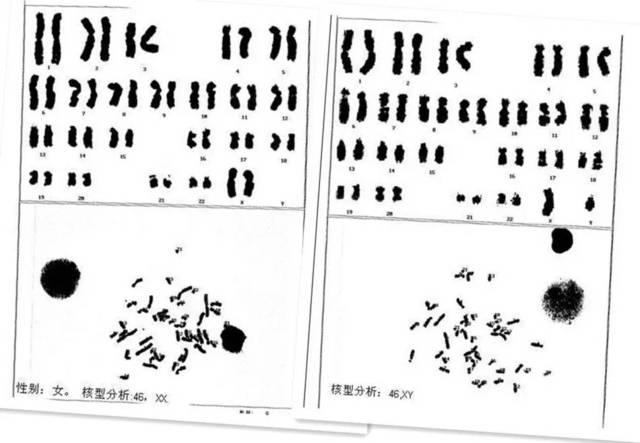 染色体核型命名如下:正常男性为46,xy,正常女性为46,xx.染色体异常(c