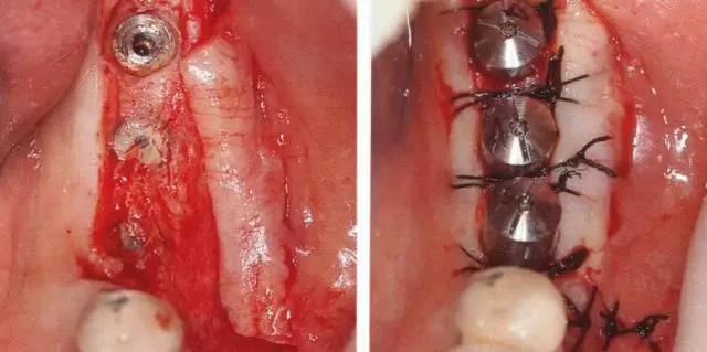 【种植与牙周组织】种植体周围角化龈的获得时期与方法