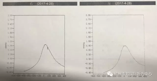 2,耳声发射:双耳均未通过