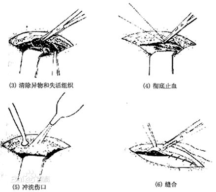 临床医师实践技能考试操作注意事项—清创缝合术