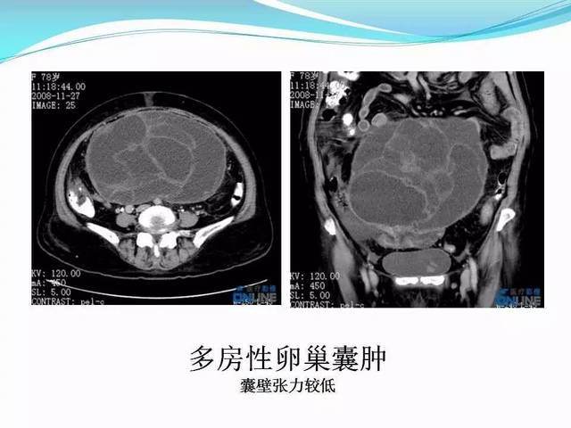 卵巢囊肿影像诊断及鉴别诊断