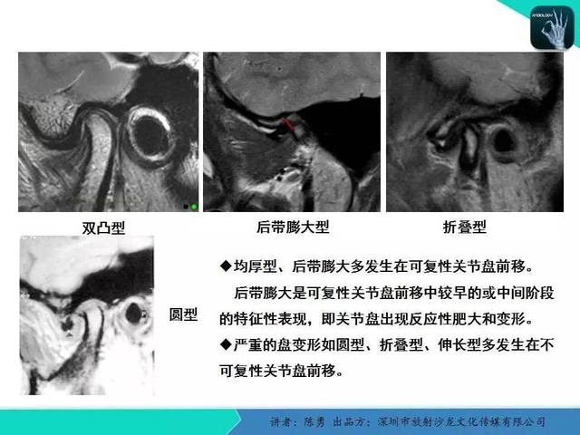 【专家大讲堂】颞下颌关节紊乱的mri诊断