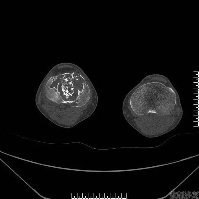 经典病例 软骨母细胞型骨肉瘤