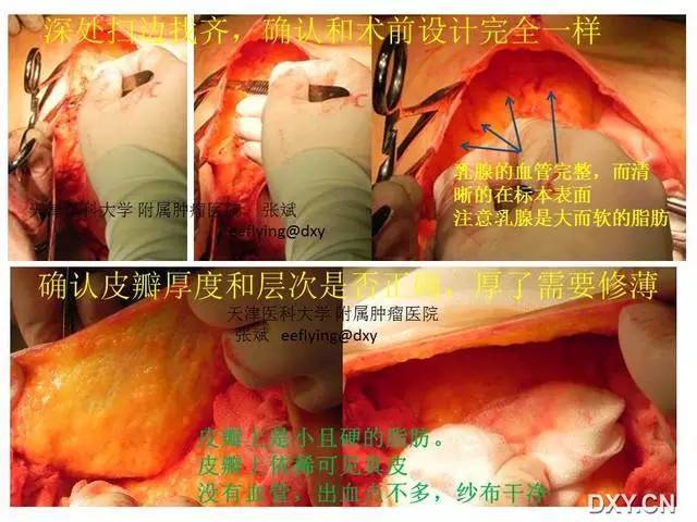 步步图解:乳腺癌根治术