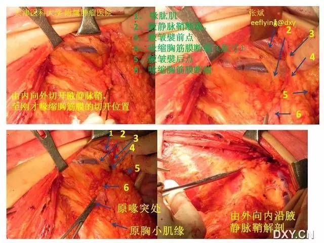 步步图解:乳腺癌根治术