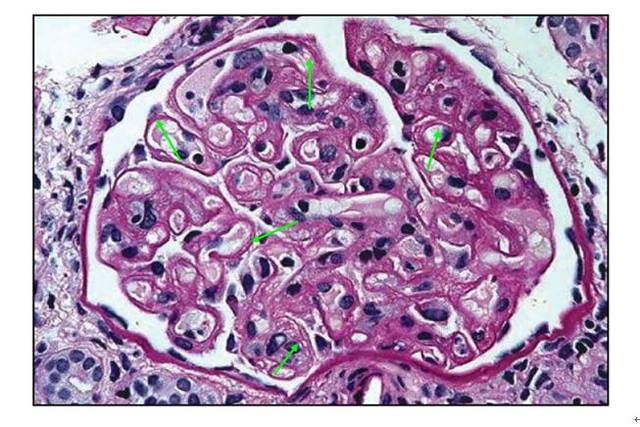 肾内病理图解:血栓性微血管病