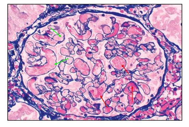 he染色:绿色箭头:肾小球毛细血管腔内纤维素样坏死;红色箭头:毛细血管