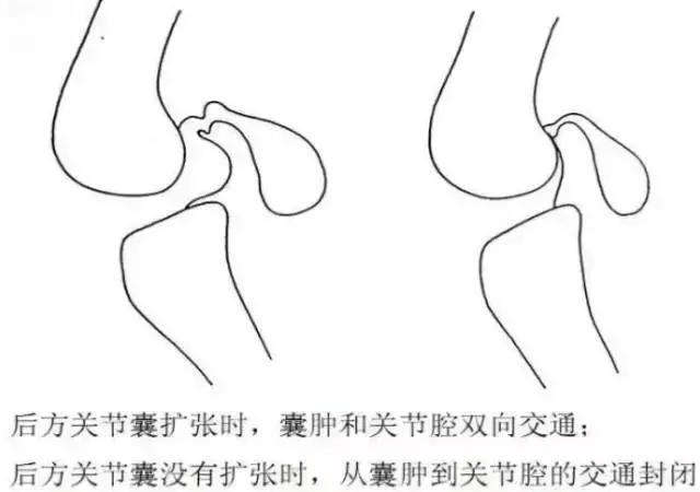 髌骨恐惧试验(patellar apprehe 21,腘窝囊肿 常见,腘窝部的不适或