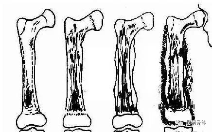 骨髓炎,一种能让你恐惧到灵魂最深处的骨病!