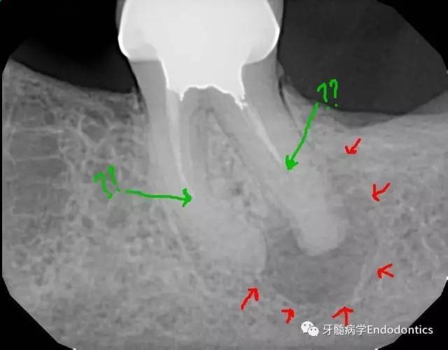 下颌第二磨牙根管再治疗一例(根管偏移,侧穿,根尖周病变愈合?
