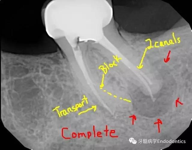 下颌第二磨牙根管再治疗一例(根管偏移,侧穿,根尖周病变愈合?