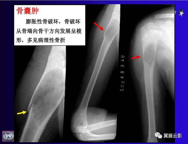 骨肿瘤ct和mri的影像表现