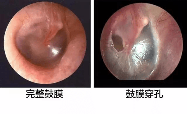 耳膜破了就听不到了[科学解说]