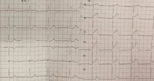 入院心电图: 窦性心律,v1~v5,v3r导联st段抬高,v7~v9导联st段下移.