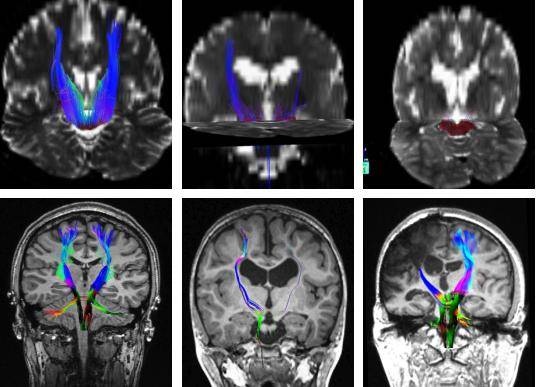 磁共振弥散张量成像技术:运动评估(mr diffusion tensor imaging,mr