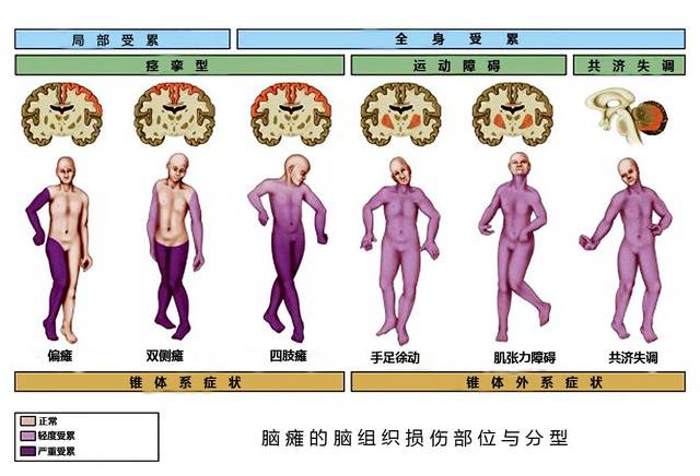 脑瘫根据临床表现可分为痉挛性瘫,运动障碍性瘫和共济失调性瘫,受累