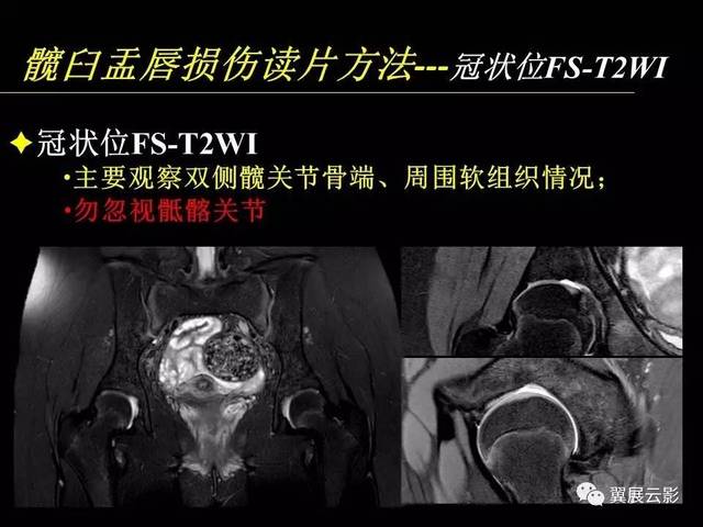 【专家课堂课后整理】髋关节撞击综合征和盂唇损伤的mr诊断