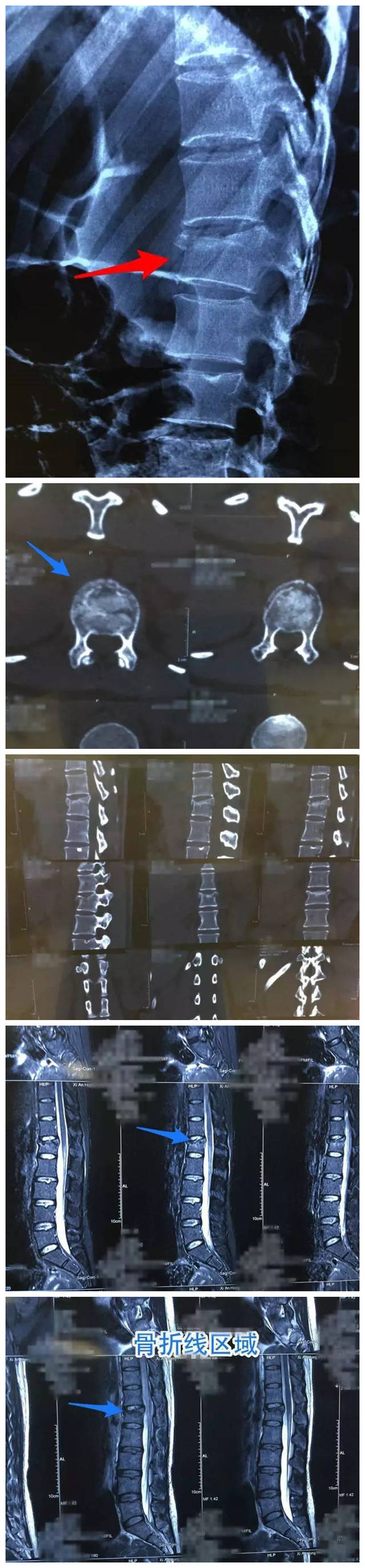 病例分享李维新江伟腰一椎体压缩性骨折