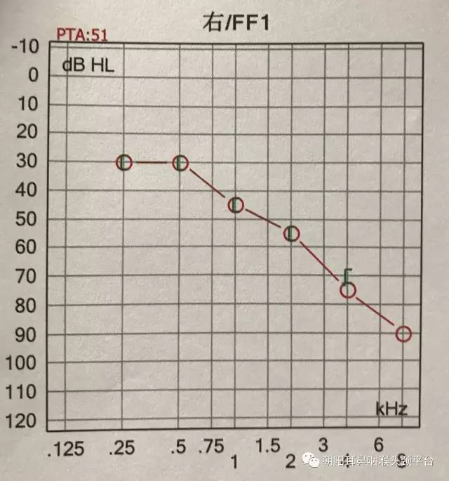 "表示;正常情况下,骨,气导应一致,且都在25db以内.
