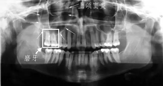 com 上颌磨牙疼痛——上颌窦炎  某些上颌磨牙急性疼痛的病因是上颌窦