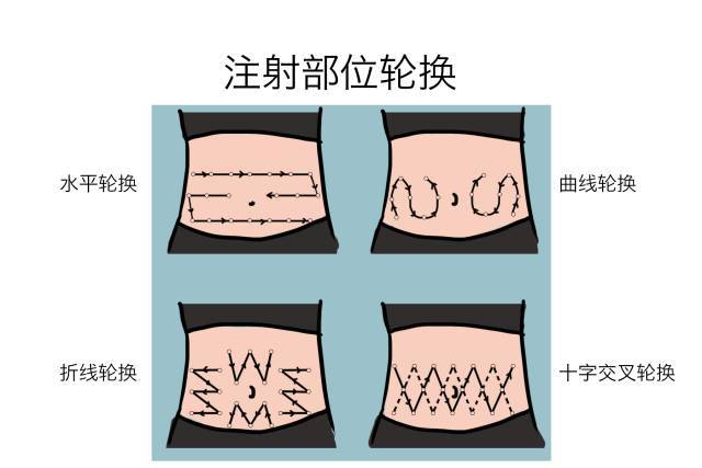 腹部注射部位轮换