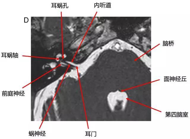 多图:桥小脑角区正常影像解剖及常见病变