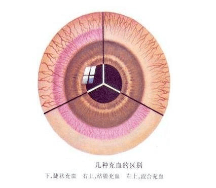 就医搜|眼睛充血,不一定是熬夜的错!