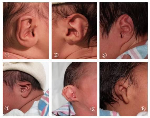 有 8 种,分别是:垂耳,stahl"s形耳,耳轮畸形,环缩耳,杯形耳,招风耳