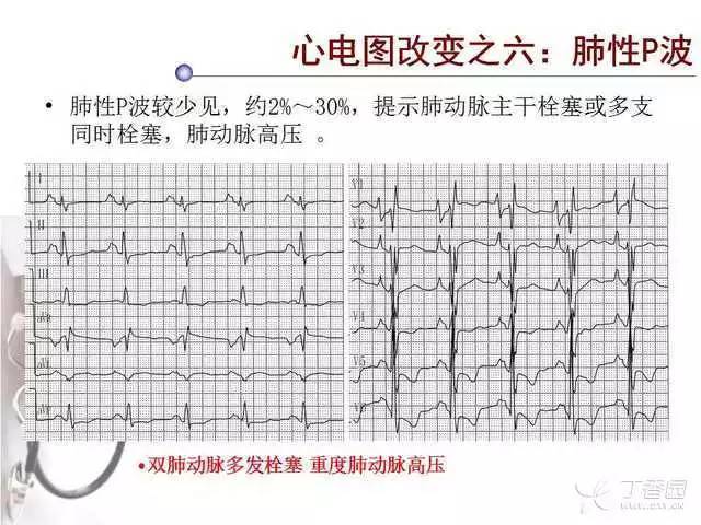 精彩幻灯:肺栓塞的心电图诊断