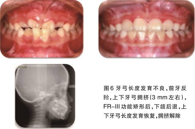 检查:混合牙列早期,上牙弓狭窄,下牙弓形态异常,上下牙列拥挤(重度)