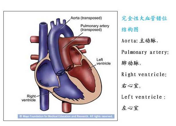 新生宝宝心脏主动脉和肺动脉长反了?