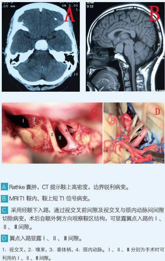 2,颞枕开颅与乙状窦前入路