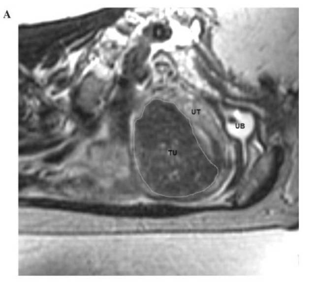 子宫腺肌症:一个不孕症病人接受磁波治疗后自