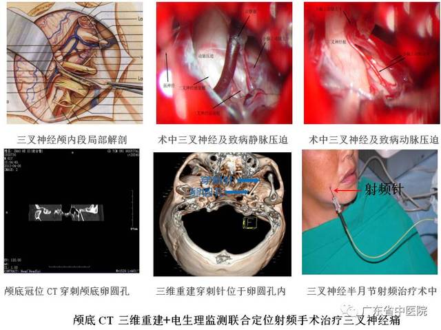 性疾病深部脑刺激术(dbs)及三叉神经痛的颅底ct薄层 电生理引导下三叉