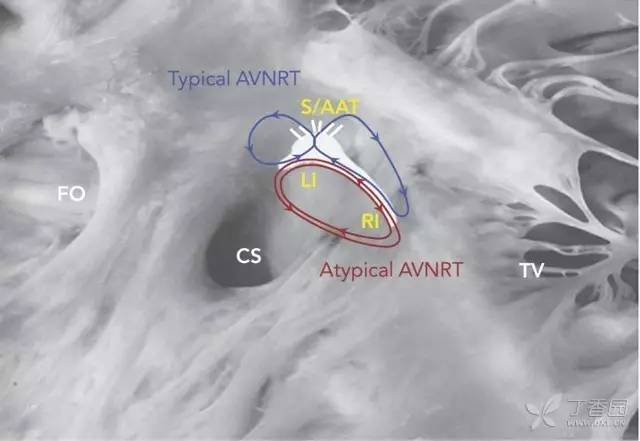 漫话心电|房室结折返性心动过速 轻松搞懂 9 大常见问题