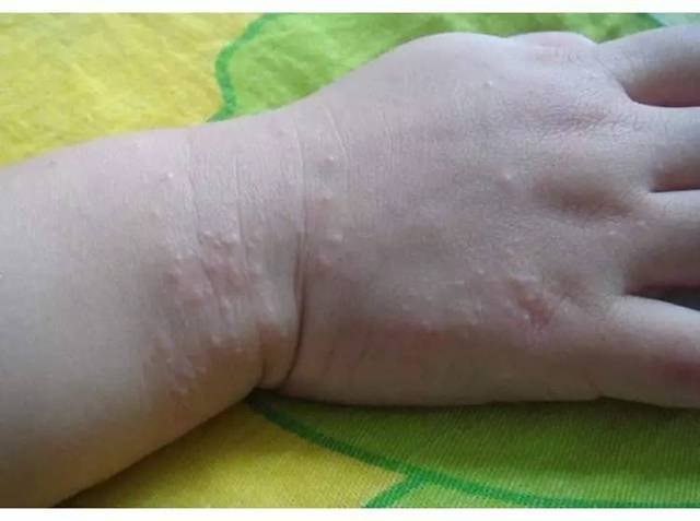 导读: ◆ 沙土皮炎又叫作摩擦性苔藓样疹,常发于2—9岁的孩子.