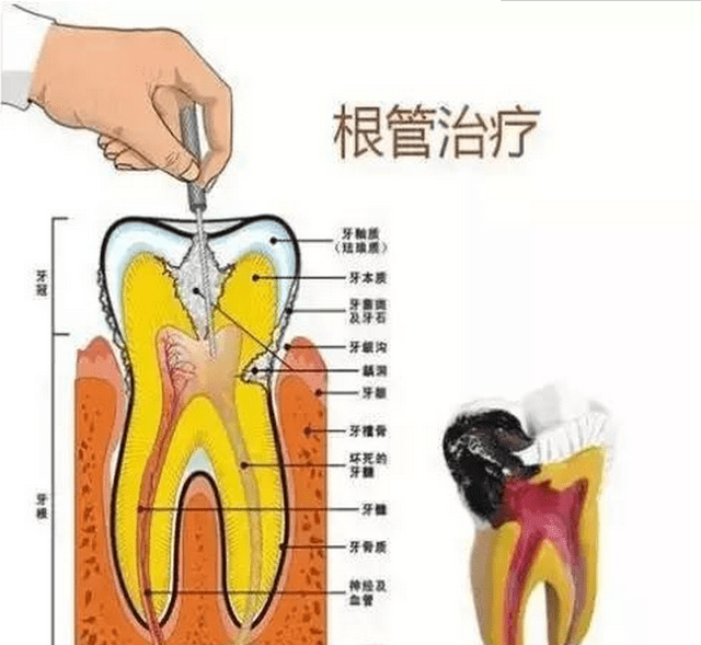 "根管治疗"就是"抽牙神经"吗?