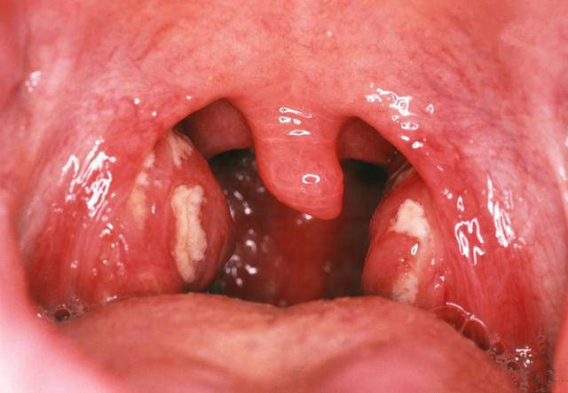 的是,急性扁桃体炎有时为某些疾病尤其是某些传染病的前驱症状,如白喉