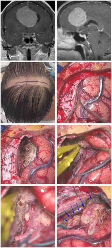 镰旁脑膜瘤手术策略与技巧 | the neurosurgical atlas全文翻译