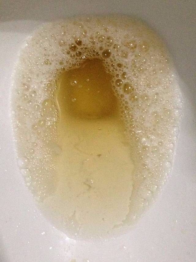 科普一下,这种尿液叫做泡沫尿,因为有泡沫,颜色又像啤酒,被人戏称为"