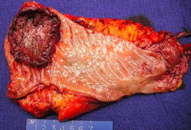 溃疡型结肠腺癌的大体标本