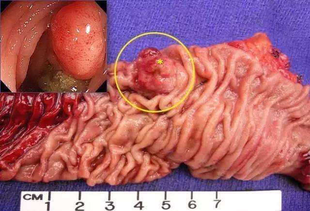 [图文全解析]结直肠癌预防,诊断治疗知识一览无余