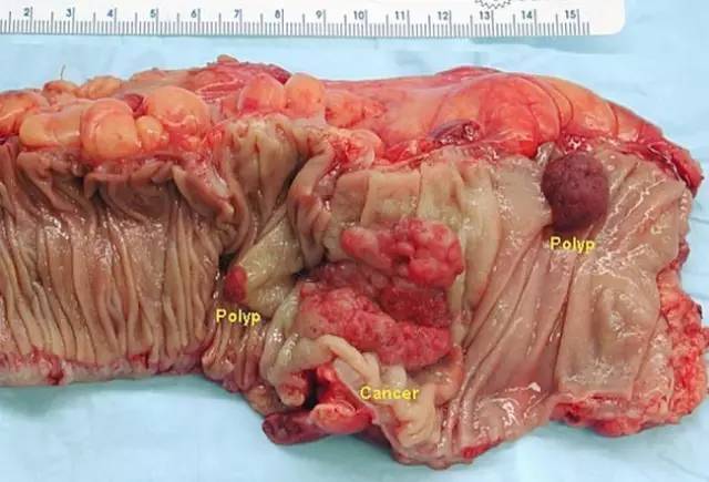 术后两个腺瘤性息肉和浸润性结直肠腺癌的大体标本