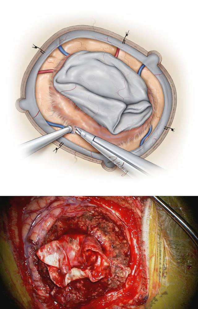 凸面脑膜瘤手术策略与技巧 the neurosurgical atlas全文翻译