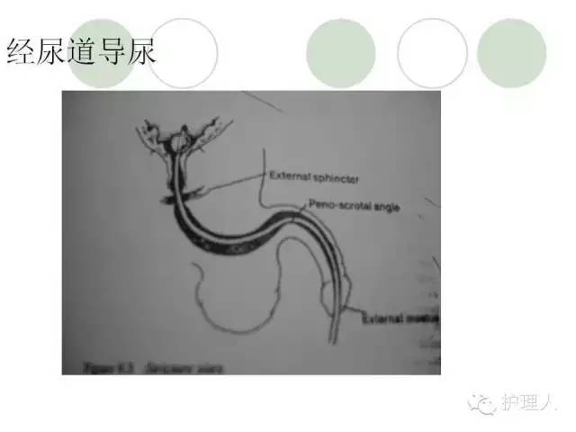 临床|导尿管的护理与固定(图文)