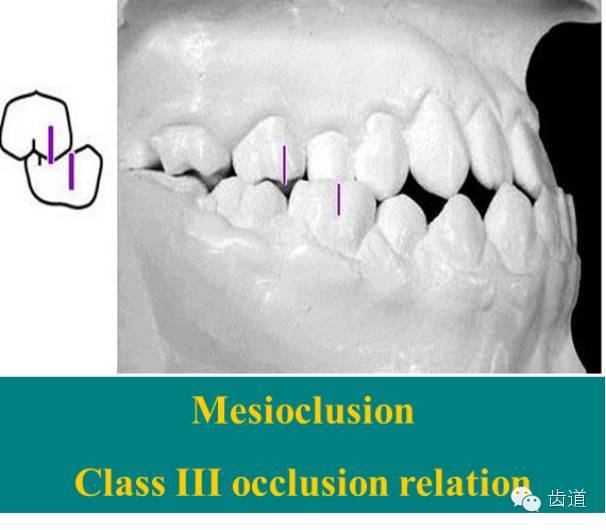 二)安氏ii类关系(远中牙合,第一磨牙) 上颌第一磨牙的近中颊尖位于