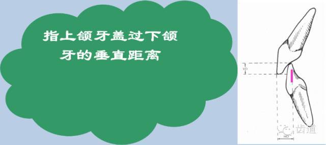 一磨牙的近中颊尖位于,下颌第一磨牙的颊沟远中 前牙有切道与切道斜度