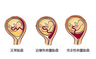 中央性前置胎盘合并妊娠期糖尿病孕妈,孕