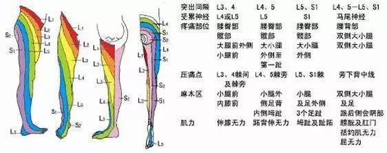 腰椎间盘突出的自我检查